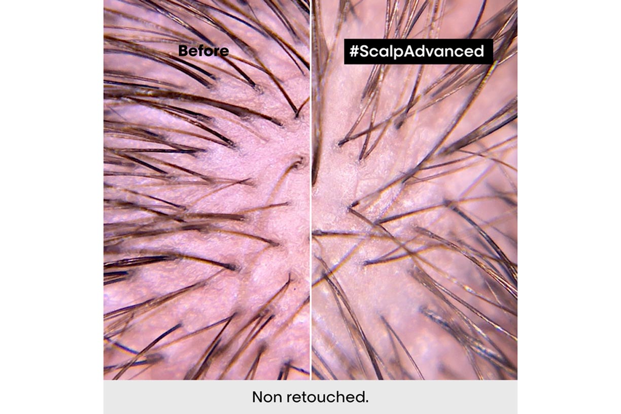 L'Oréal Scalp Advanced Anti-Oiliness range